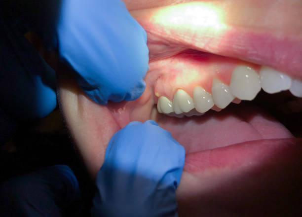 Best Emergency Dental Care for Sports Injuries in Bargaintown, NJ