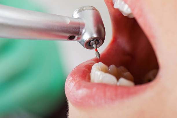 Best Emergency Wisdom Tooth Extraction in Bargaintown, NJ